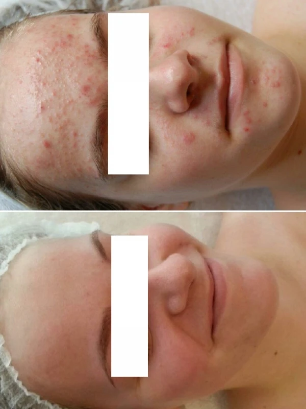 acne specialist voor en na den bosch